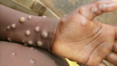 Photo of OMS confirma quase 100 casos de varíola dos macacos fora da região endêmica